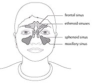 sinusitis2.jpg